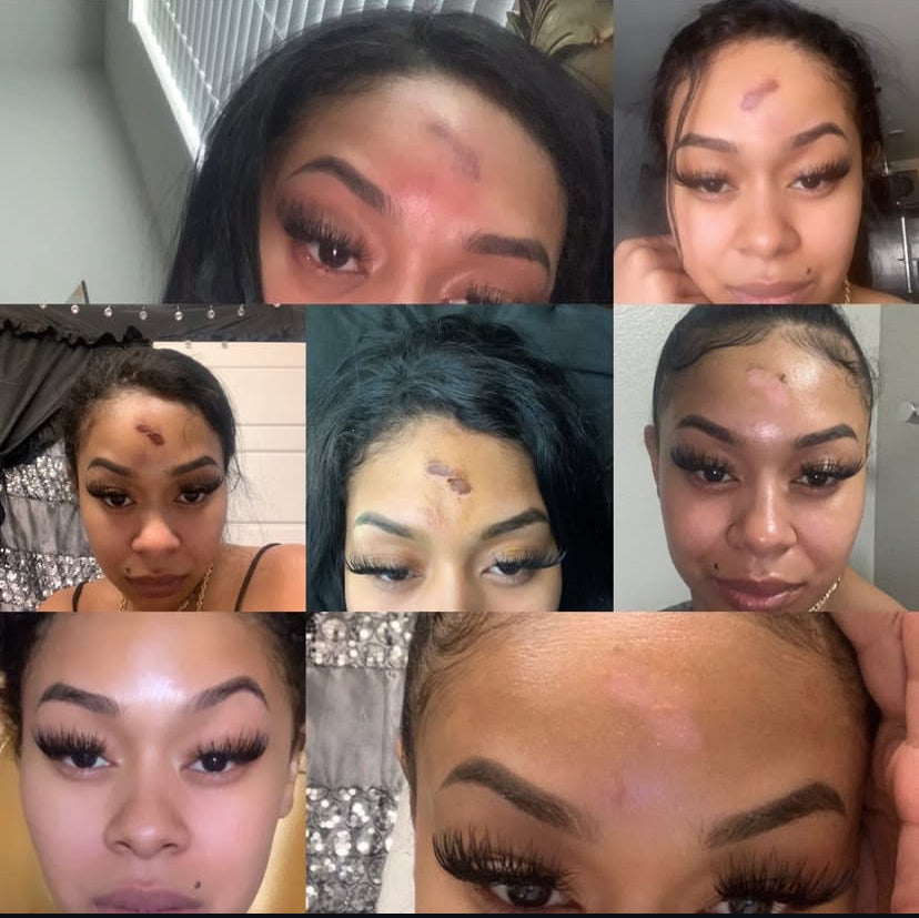 Handmade Facial Acne Cleanser